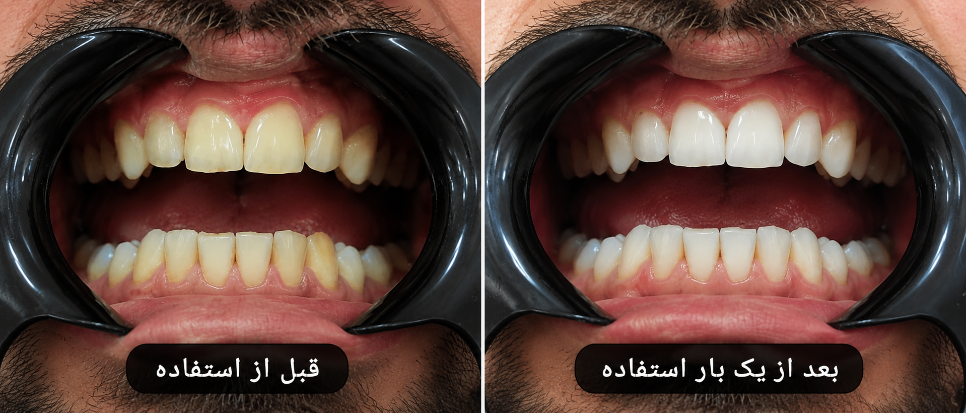 بلیچینگ خانگی تیروژ - بعد از یکبار استفاده