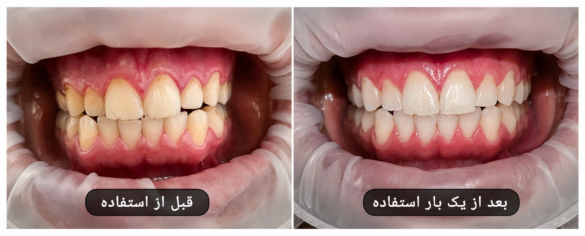 عملکرد ژل بلیچینگ خانگی تیروژ | تاثیر بدون حساسیت و ماندگار