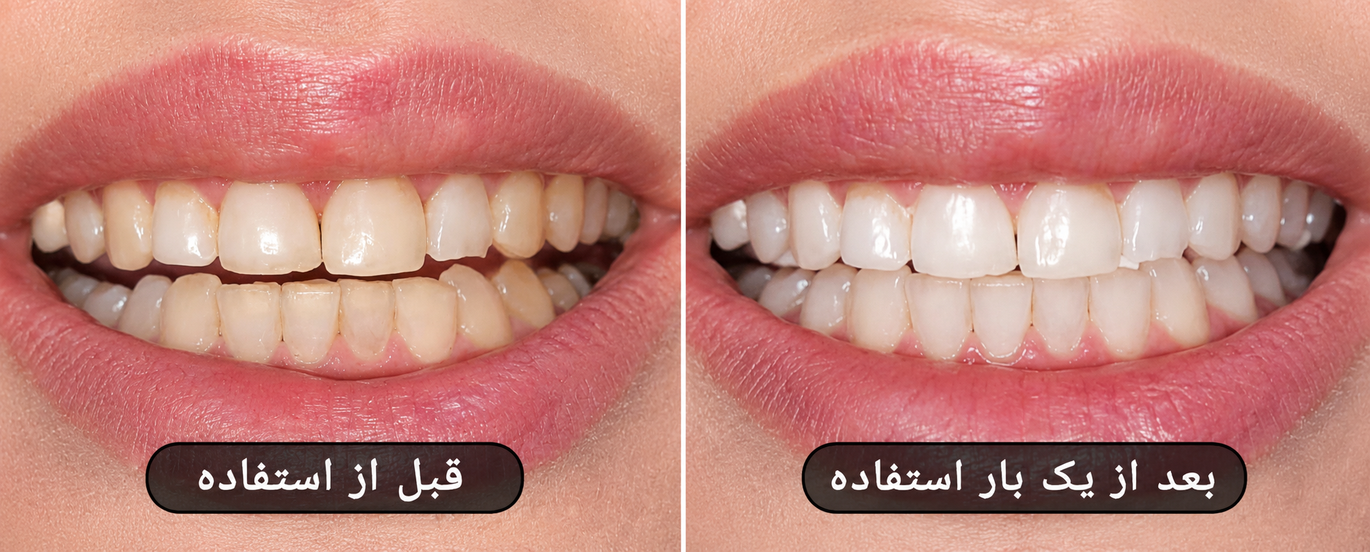 بلیچینگ خانگی تیروژ - بعد از یکبار استفاده