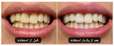 کیت بلیچینگ خانگی تیروژ یک فک - حاوی ژل بلیچینگ و ضد حساسیت